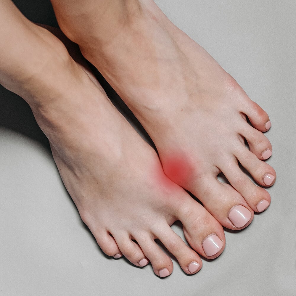 https://www.minfot.se/pub_docs/files/404content/hallux-valgus.jpg