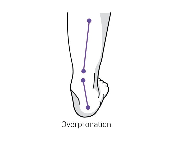 https://www.minfot.se/pub_docs/files/Hurvetjagomjagpronerarellersupinerar/overpronation.jpg