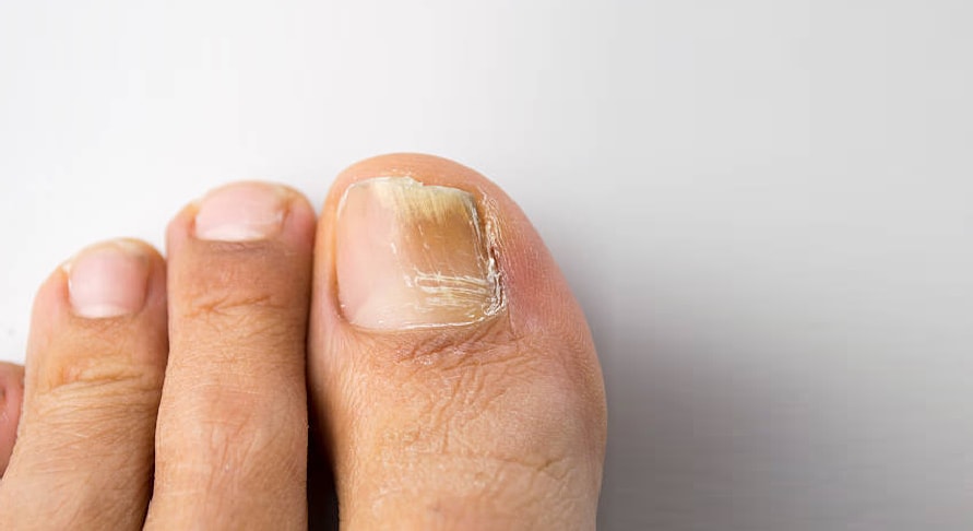 Hur får man bort nagelsvamp fort?